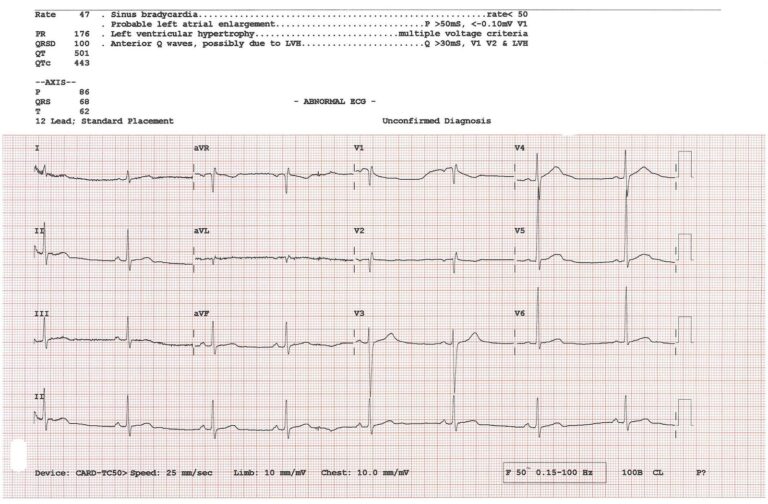 Bir elektrokardiyografi (EKG) kaydı