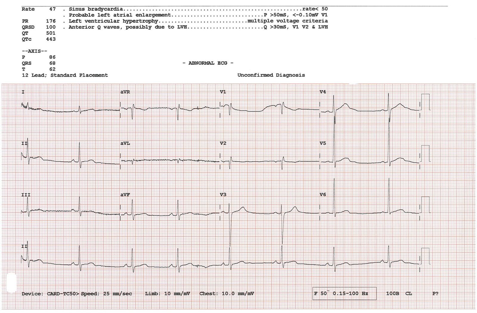 Bir elektrokardiyografi (EKG) kaydı
